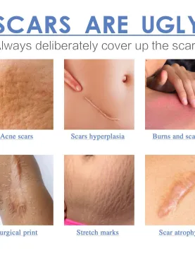 South Moon Silicone Scar Sheets