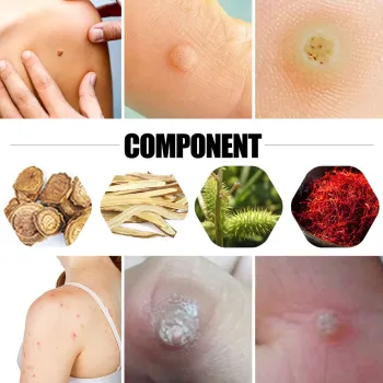 South Moon Corn Removal Plaster